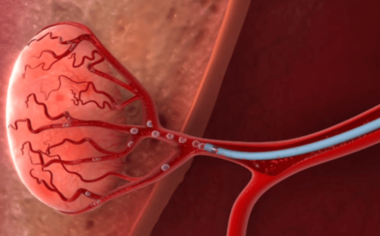 Blog Emboliza O De Miomas Tratamento Preserva O Do Tero